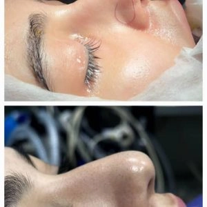 جراحی بینی توسط دکتر احسانی