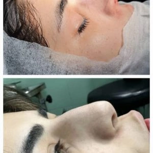جراحی بینی در مطب